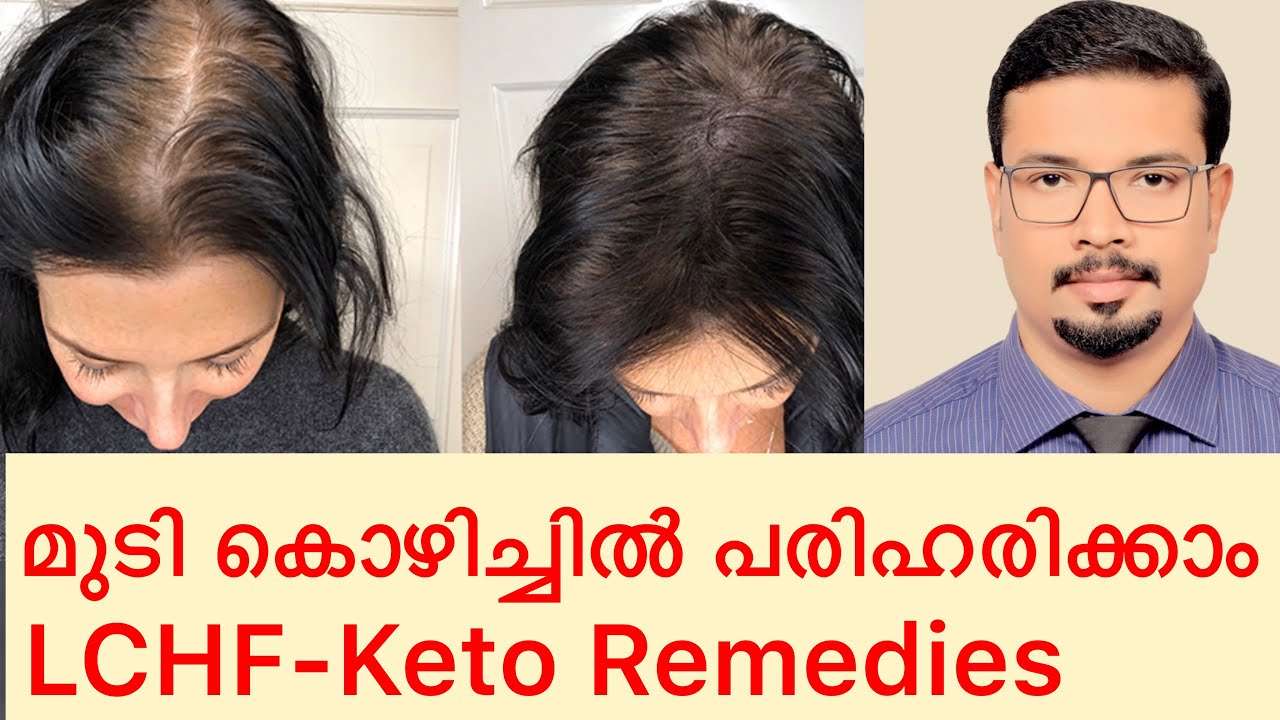 How to control hair loss in Keto Diet